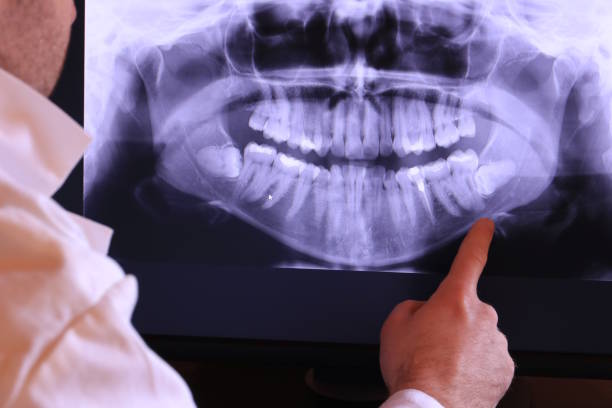 Best Emergency Dentist for Lost Fillings or Crowns in East Vineland, NJ